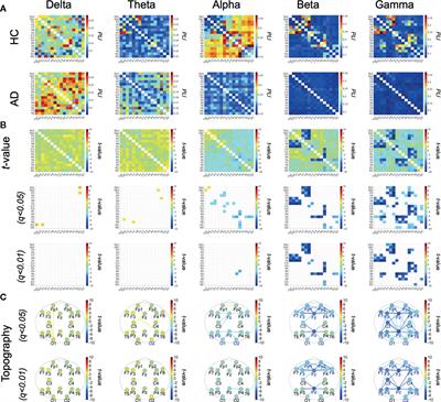 Classification Methods Based on Complexity and Synchronization of Electroencephalography Signals in Alzheimer’s Disease